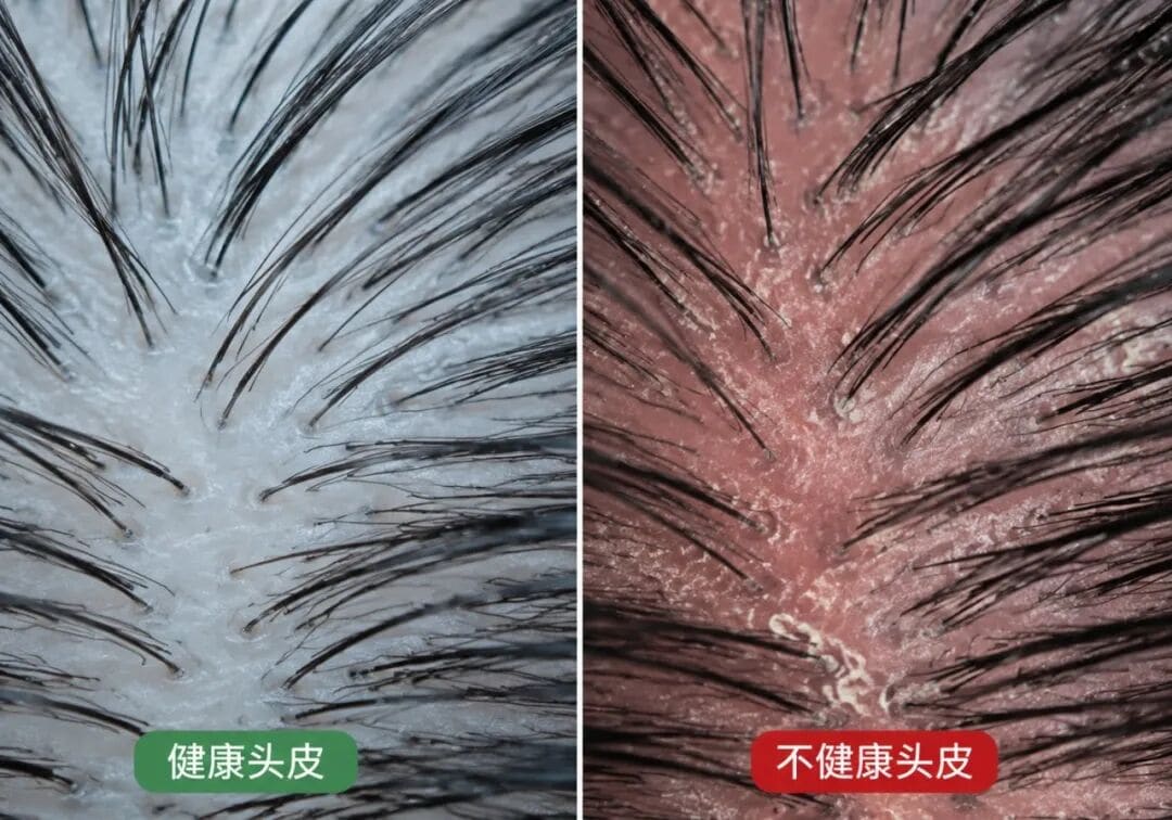 合生和做养发之前,为什么要先做头皮检测?一分钟告诉你答案 合生和做养发之前,为什么要先做头皮检测?一分钟告诉你答案