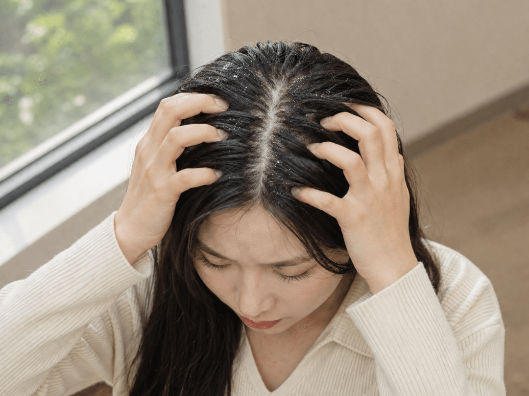 夏天头发越洗越油?可能是你的头皮正在“求救” 夏天头发越洗越油?可能是你的头皮正在“求救”