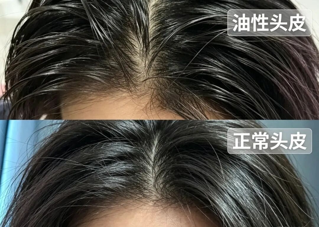 夏天每天洗头还是油？合生和常见的5种油头，看看你是哪种