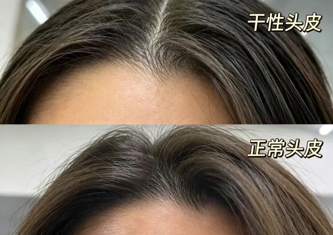 夏天每天洗头还是油？合生和常见的5种油头，看看你是哪种