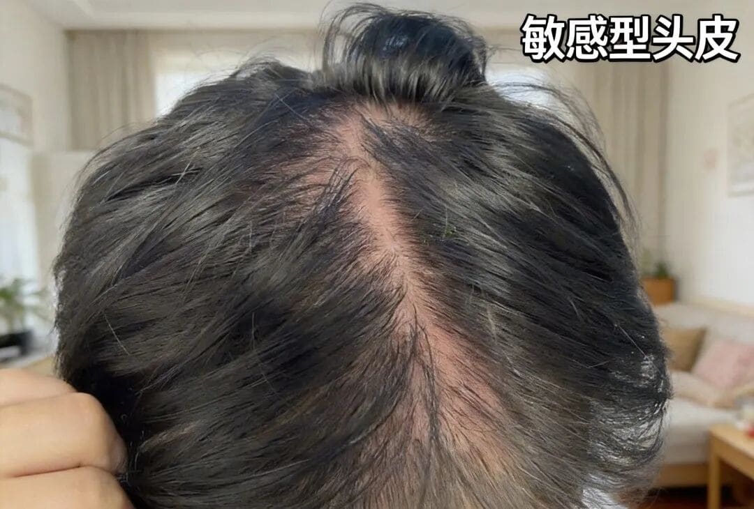 夏天每天洗头还是油？合生和常见的5种油头，看看你是哪种